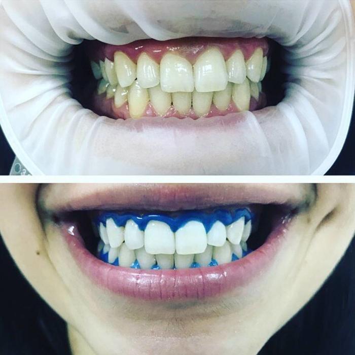профессиональное отбеливание зубов amazing white клиническое отбеливание